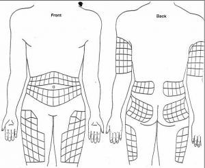 Insulin Injection sites